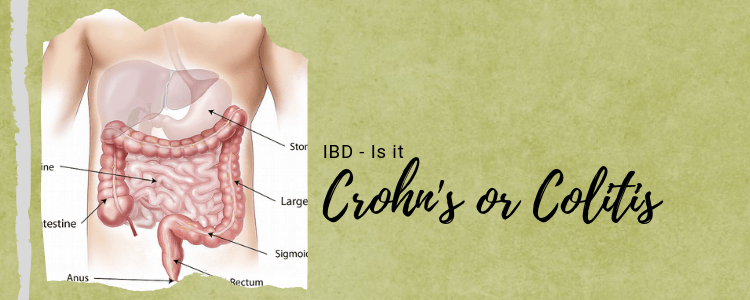 IBD – Is It Crohn’s Or Colitis?