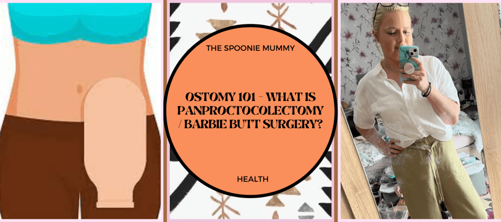 Ostomy 101 – What is Panproctocolectomy/Barbie Butt Surgery