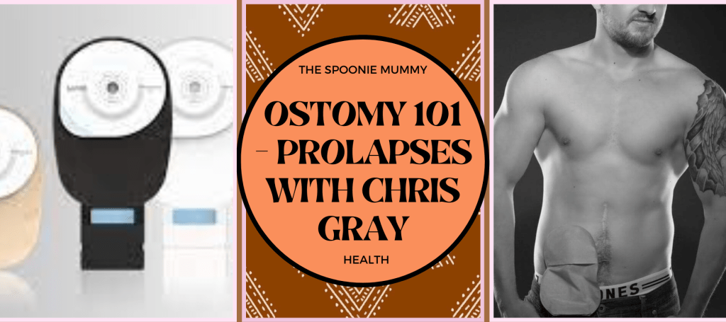 Ostomy 101 – Prolapses with Chris Gray