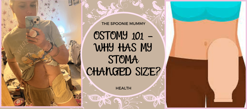 Ostomy 101 – Why Has My Ostomy Changed Size?